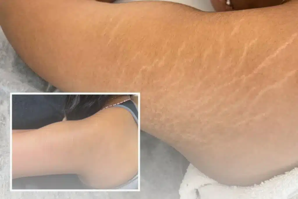 Stretch Mark Treatment