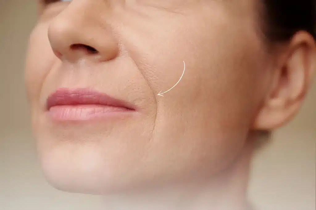 Nasolabial Filler