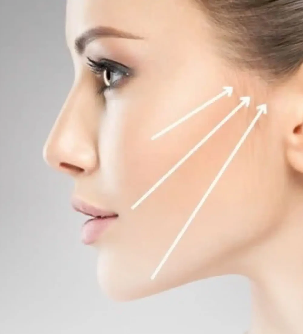 Cheek Filler