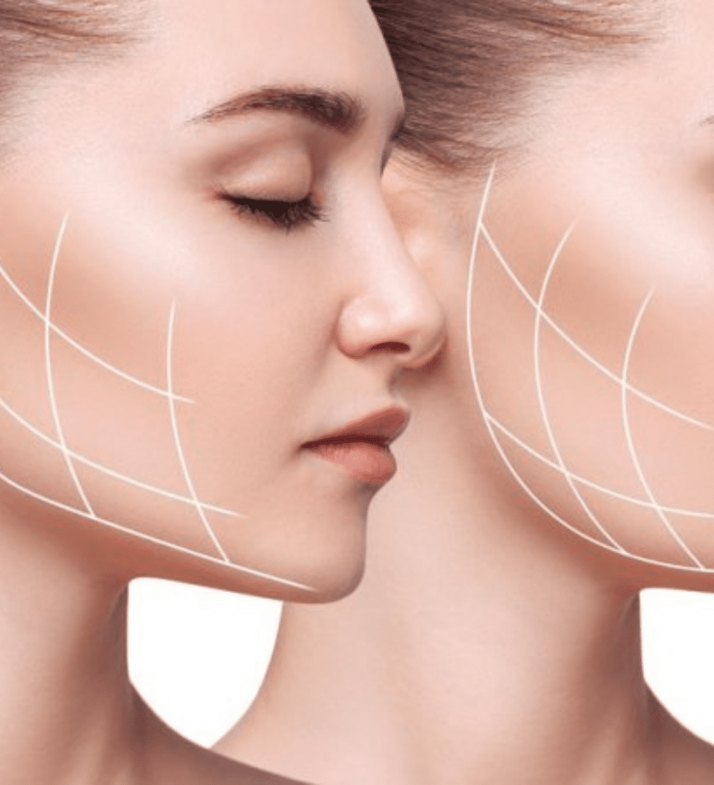 Jawline Filler