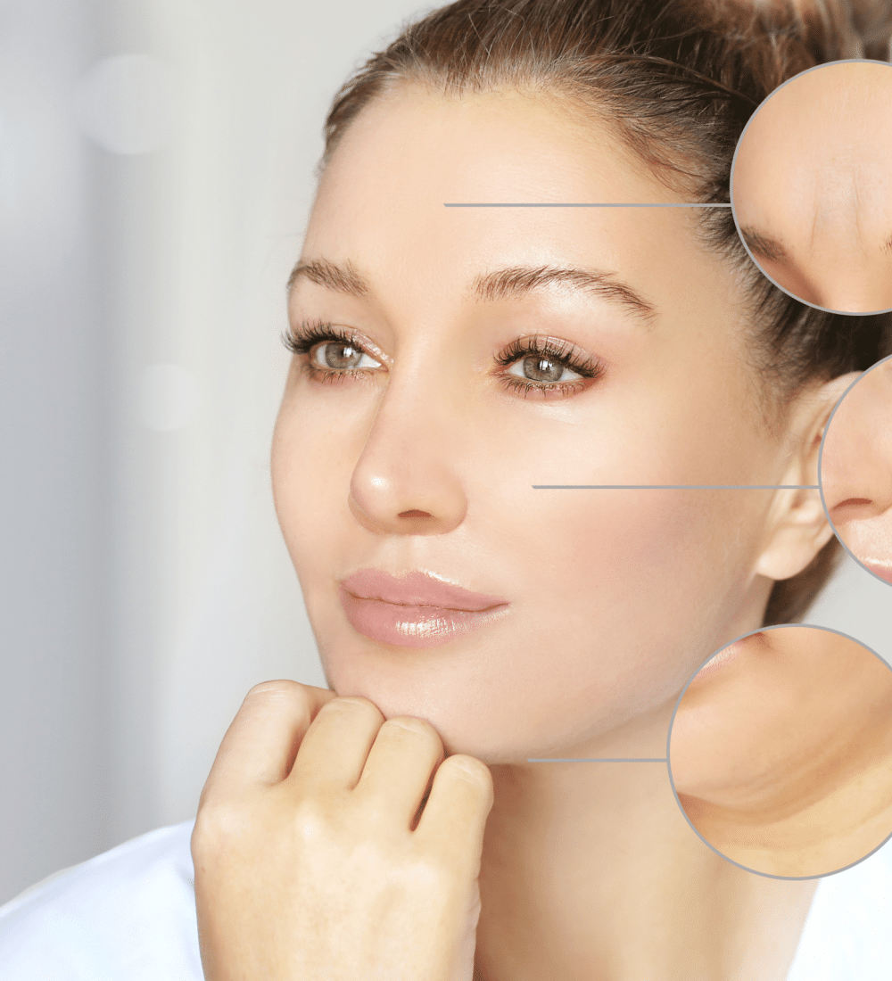 Nasolabial Filler