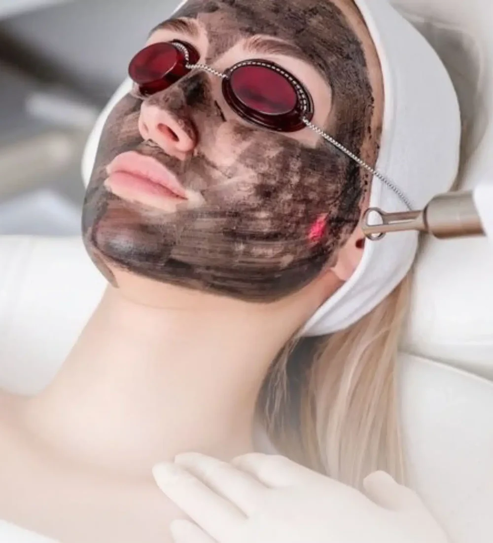 Pico Lazer Teknolojisi İle Karbon Peeling