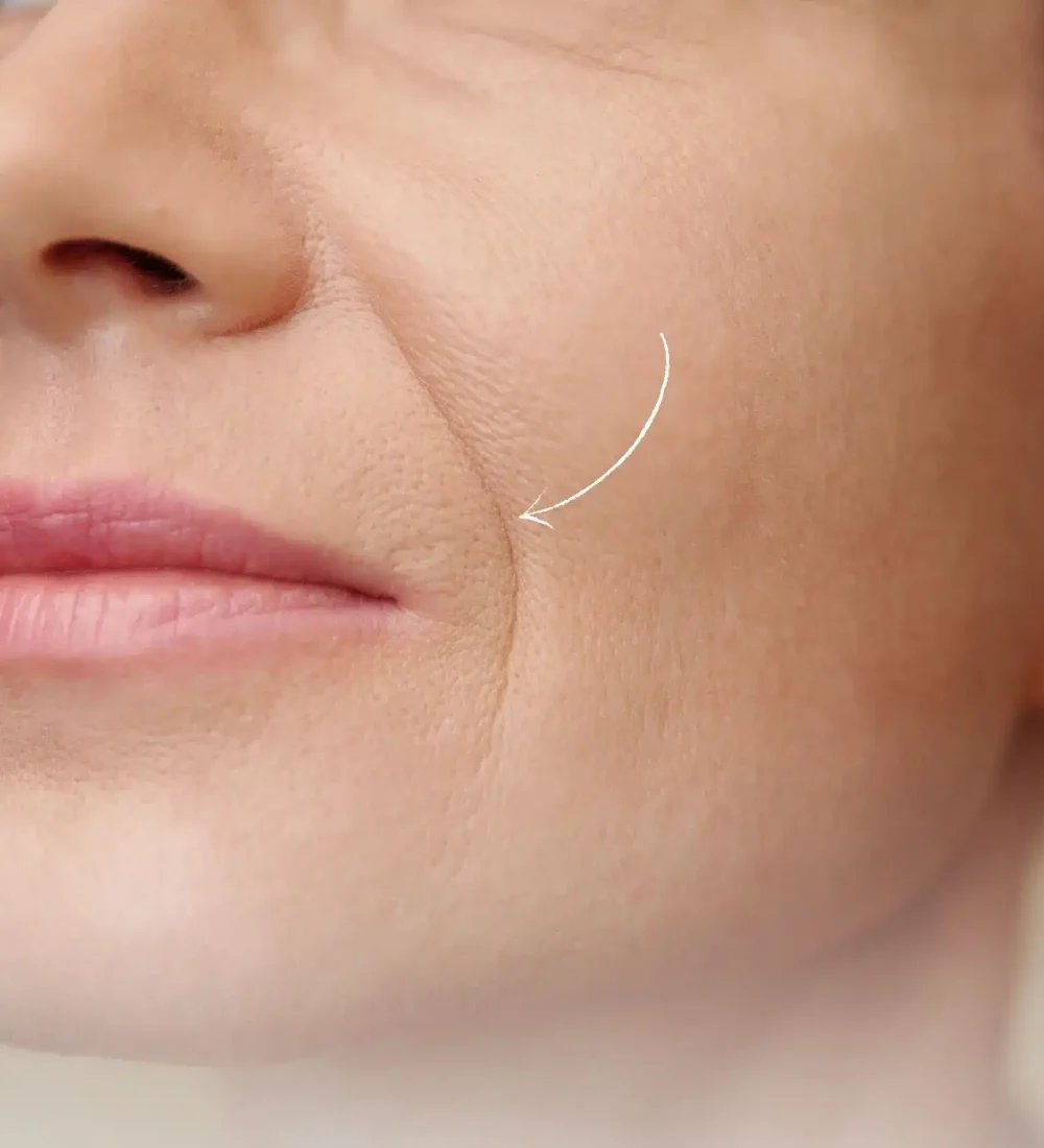 Nasolabial Filler